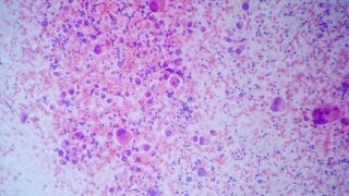 Non small cell lung tumor