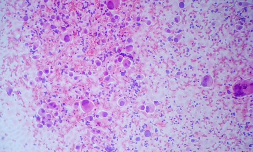 Non small cell lung tumor